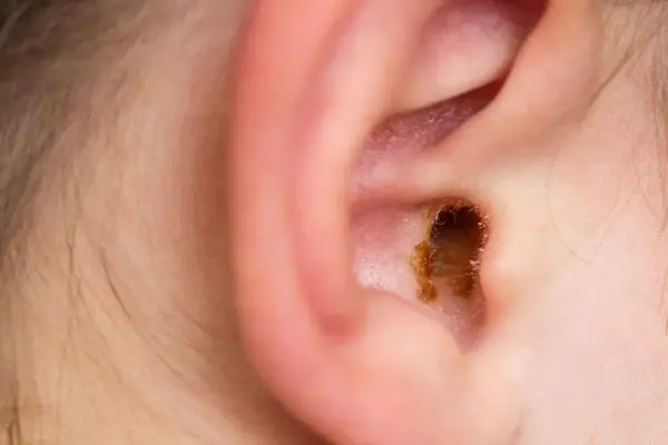 earwax build-up